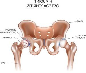 髋关节骨关节炎和健康髋关节